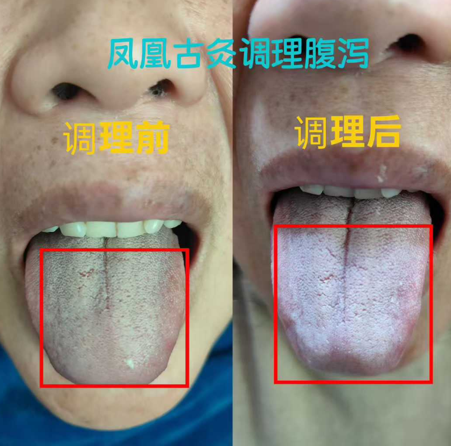 一夜腹泻8次？凤凰古灸温阳固脾，快速挽回元气