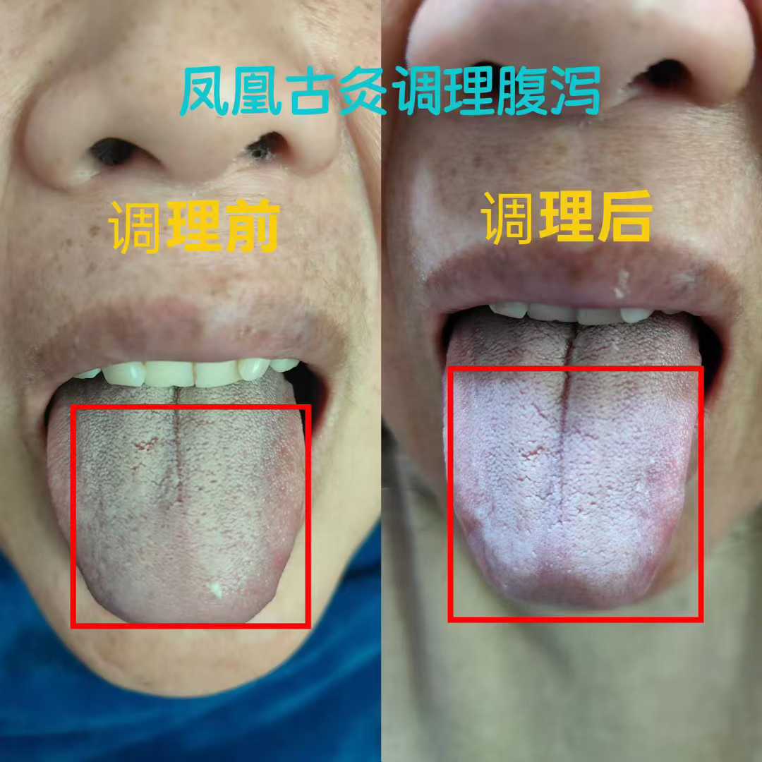 寒湿致泻、气血亏虚？凤凰古灸对症调理，从根养好脾胃